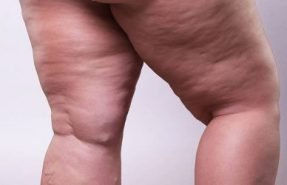 lipedema