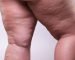 lipedema