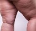 lipedema