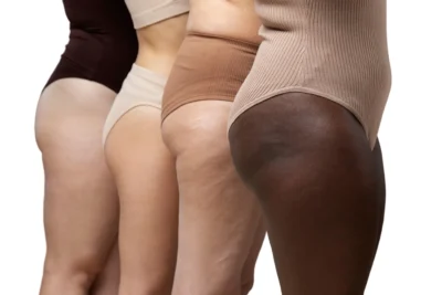 LIPEDEMA Clínica de Fisioterapia Mujer lipedema que es