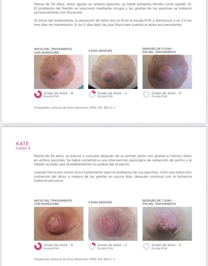IMG_5369.jpg Fisioterapia para la Mujer - NURSICARE (GRIETAS PECHO)