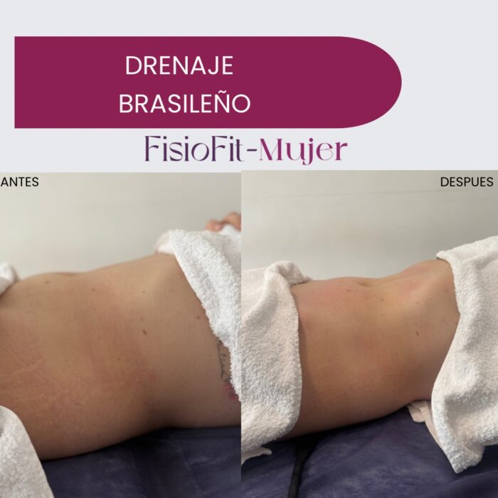 Fisioterapia para la Mujer - Sesión Drenaje Brasileño & Drenaje linfatico