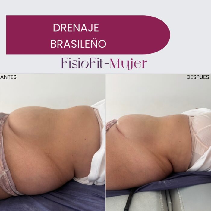 Fisioterapia para la Mujer - Sesión Drenaje Brasileño & Drenaje linfatico