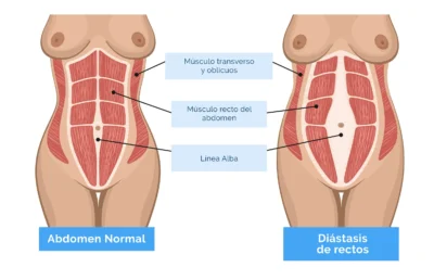 diastasis abdominal ejercicios