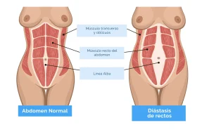 diastasis abdominal ejercicios