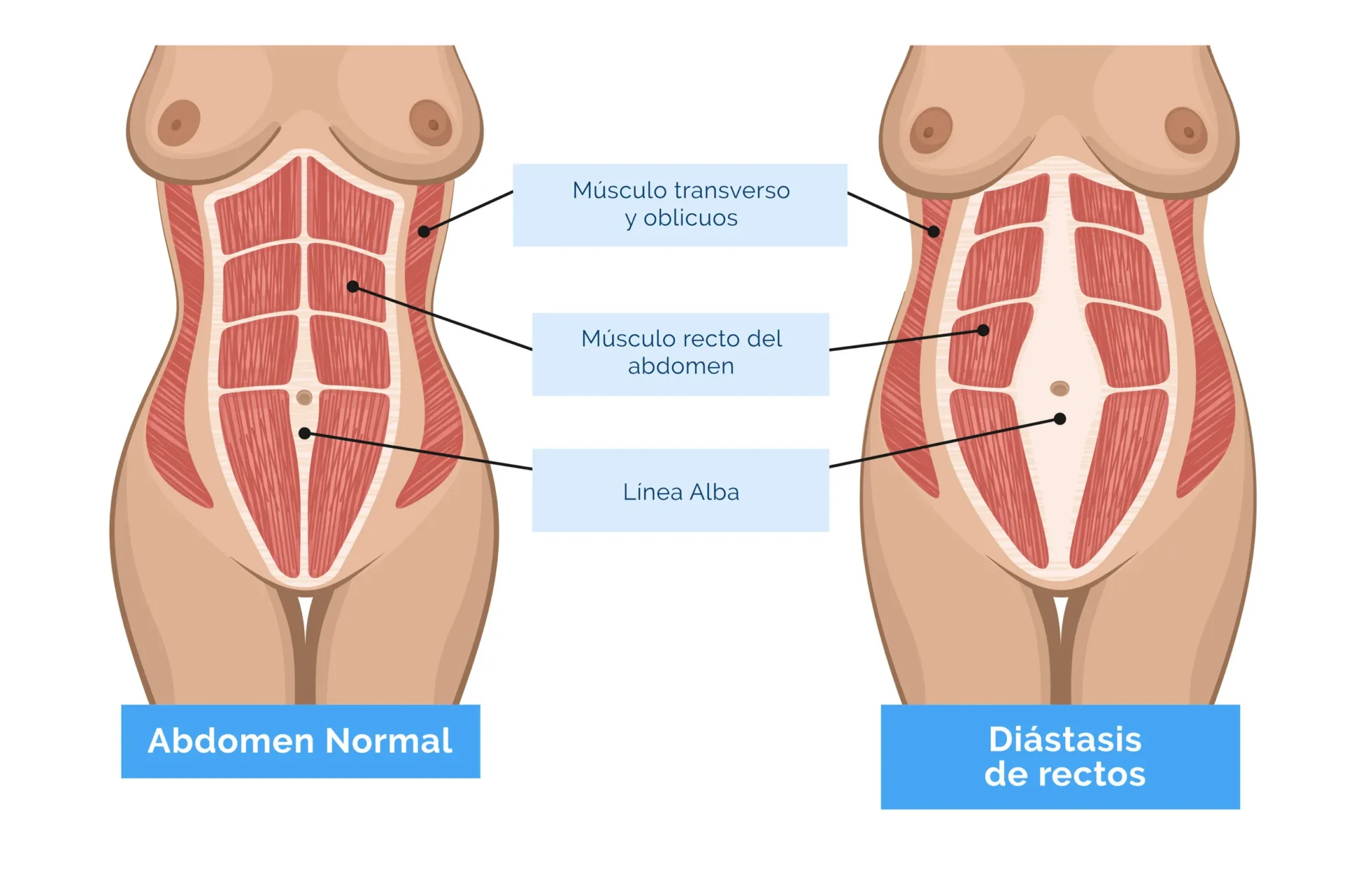 Diastásis abdominal: más allá de los ejercicios Clínica de Fisioterapia Mujer diastasis abdominal ejercicios