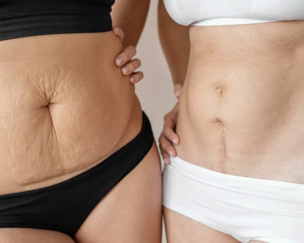 Cicatrices abdominales y del periné Clínica de Fisioterapia Mujer cicatrices abdominales