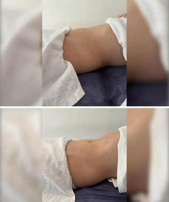 Drenaje Linfático Brasileño Madrid Clínica de Fisioterapia Mujer drenaje brasileno en madrid