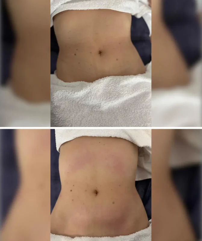 Drenaje Linfático Brasileño Madrid Clínica de Fisioterapia Mujer drenaje linfatico brasileno en madrid