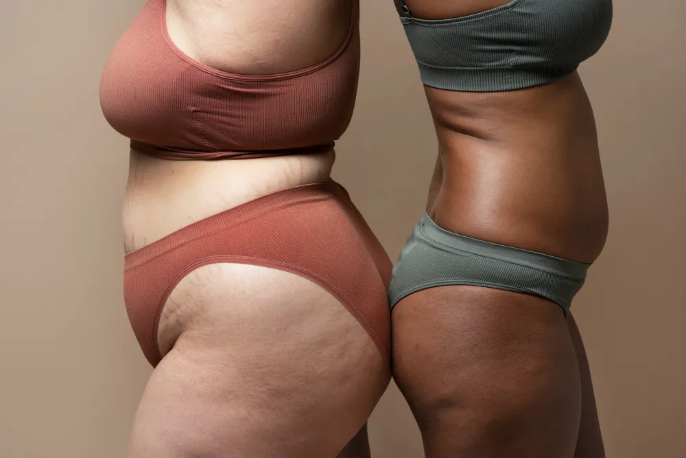 LIPEDEMA Clínica de Fisioterapia Mujer lipedema tratamiento